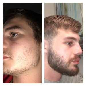 minoxidil para barba