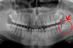 radiografia de siso incluso