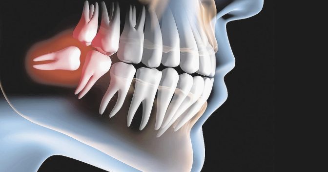 Qualidade de Vida: Quanto tempo leva para o dente siso nascer completamente?